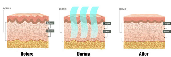 Ultra-Cavitation