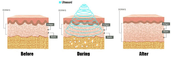 Ultra-Cavitation